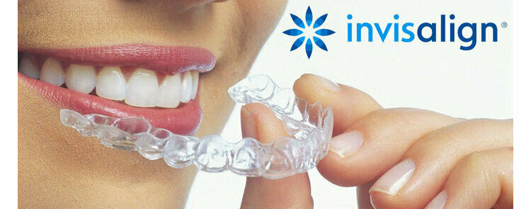 My Invisalign Journey (a prospective from a patients view point)